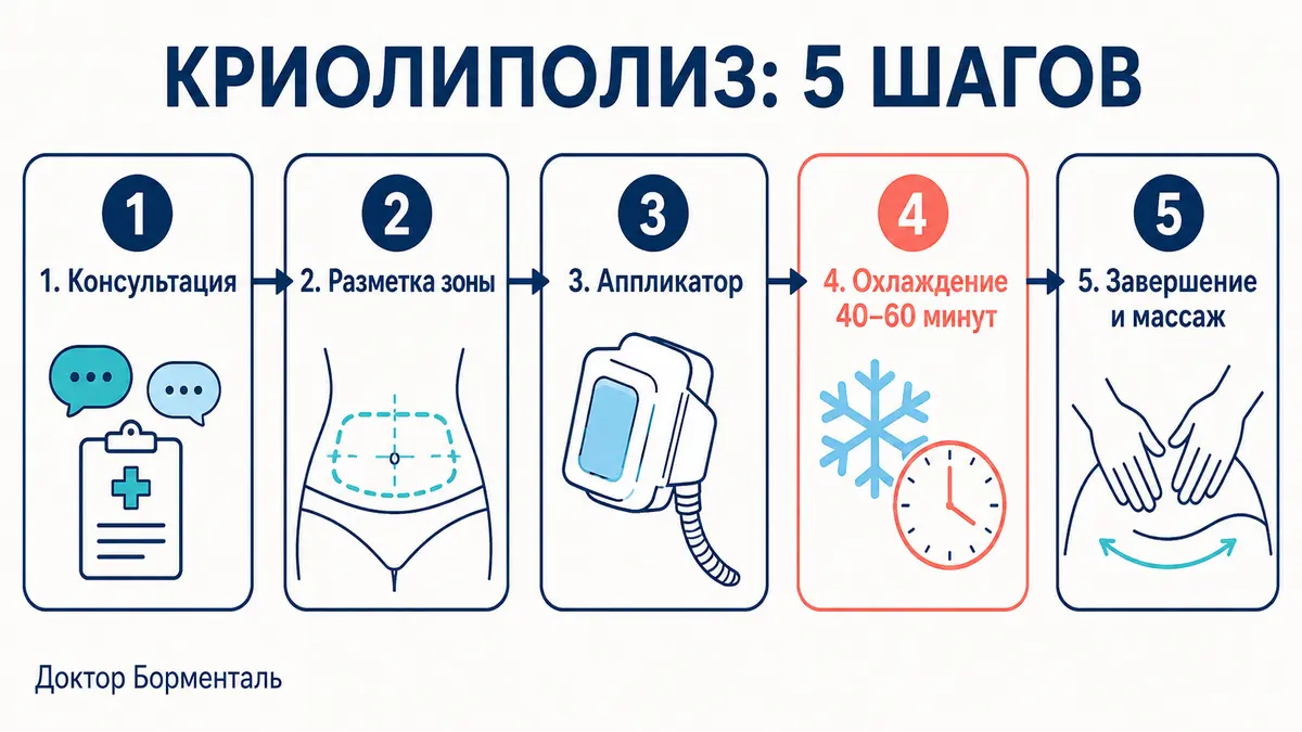 Как проходит процедура криолиполиза: 5 шагов от консультации до массажа зоны