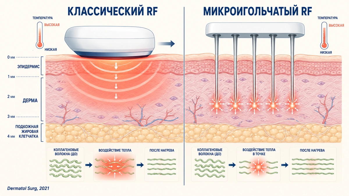 Микроигольчатый и классический RF: схема распределения энергии в слоях кожи